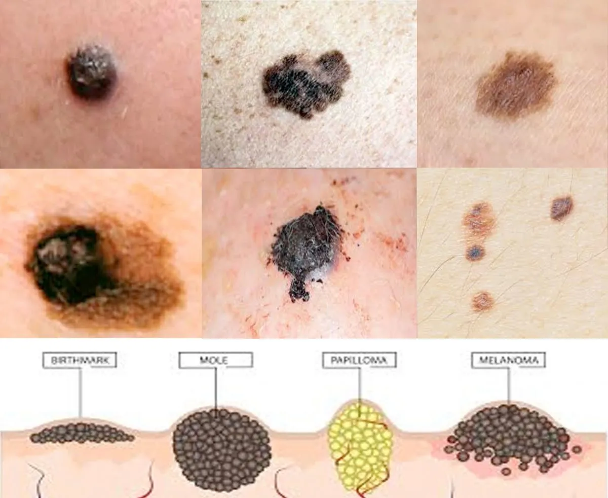 Skin Cancer Types And Information - Almeda Healthcare